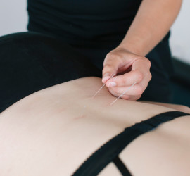 Acupuncture at Central Lakes Physio Wanaka